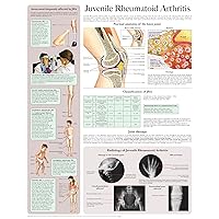 Juvenile Rheumatoid Arthritis e-chart: Quick reference guide