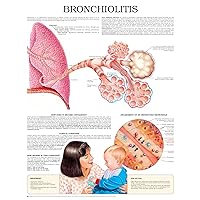 Bronchiolitis e chart: Full illustrated