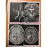 cerebral hemorrhage (Japanese Edition)