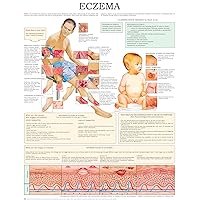 Eczema e-chart: Quick reference guide