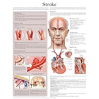 Stroke e-chart: Full illustrated