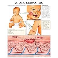 Atopic dermatitis: Full illustrated Atopic dermatitis: Full illustrated Kindle Hardcover
