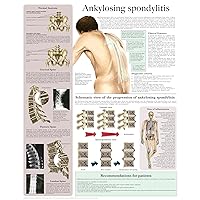 Ankylosing spondylitis e-chart: Quick reference guide