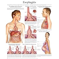 Esophagitis e-chart: Full illustrated