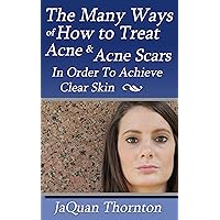 The Many Ways of How to treat Acne and Acne Scars in order to achieve clear skin