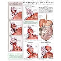 Gastroesophageal reflux disease e-chart: Full illustrated