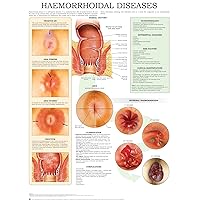 Haemorrhoidal Diseases e-chart: Quick reference guide