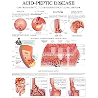 Acid-peptic disease - e-chart: Gastritis-peptic ulcer-gastroesophageal reflux