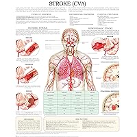 Stroke (CVA) e-chart: Quick reference guide