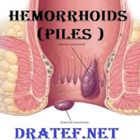 Hemorrhoids (Piles)
