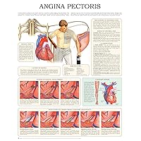 Angina pectoris e-chart: Quick reference guide