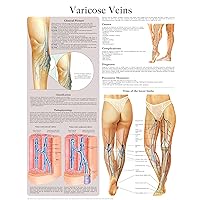 Varicose Veins e-chart: Full illustrated Varicose Veins e-chart: Full illustrated Kindle
