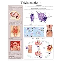 Trichomoniasis e-chart: Full illustrated