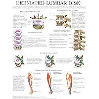Herniated Lumbar Disk - Quick Reference Chart: Full illustrated