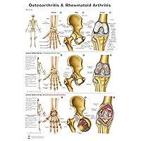 Osteoarthritis & Rheumatoid Arthritis, Chart (PVC, 24x36 inch)