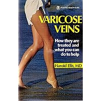 Varicose Veins: How They Are Treated and What You Can Do to Help Varicose Veins: How They Are Treated and What You Can Do to Help Paperback